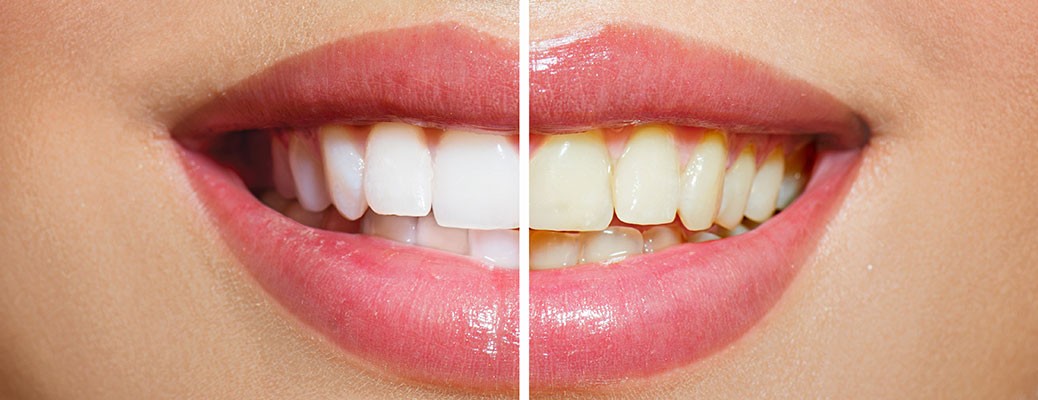 Teeth-Whitening